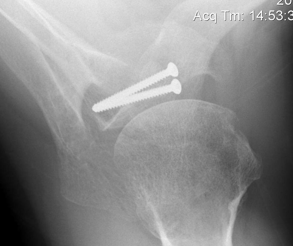 Latarjet Axillary Lateral